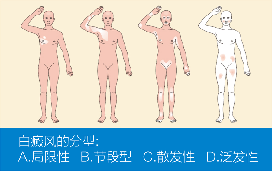 王宏伟教授专栏|白癜风相关知识科普(图2)